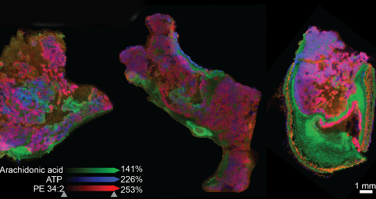 mass spectrometry image of pancreatic tumours