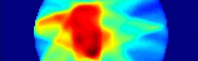 Intensity Modulated Radiation Therapy